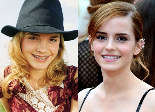 can-braces-change-your-face-shape